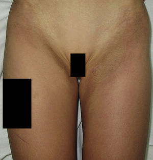Residual hyperpigmentation without sclerosis after treatment with oral corticosteroids and methotrexate.