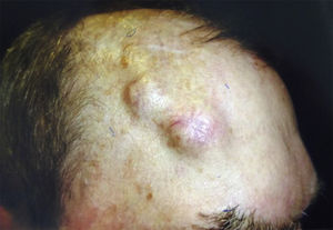 Clinical perineural infiltration: supraorbital nerve thickening.