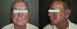Clinical perineural infiltration of the facial nerve.