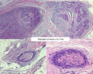 Significant perineural infiltration: diameter of nerve greater than 0.1mm.