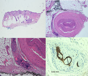 Perineural infiltration in nerves measuring less than 0.1mm in diameter, although at some distance from the main focus of the tumor.