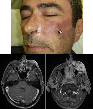 Perineural infiltration of the maxillary branch (V2).