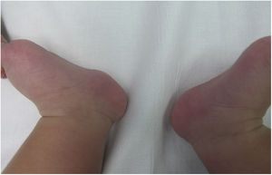 Clinical image of a fibrolipomatous hamartoma in a 5-month-old girl. The image shows a flesh-colored tumor with a soft consistency on the precalcaneal region of the left heel.