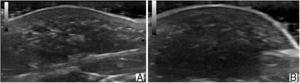 Ultrasound image (18MHz) of fibrolipomatous hamartoma. A, Longitudinal plane (A). B, Transversal plane (B). Note the thickening of the dermis and hypodermis at the expense of hypoechoic islands with fatty echogenicity intermingled between hyperechoic lines in the deep dermis, which extend to the subcutaneous cellular tissue.