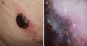 A, Fast-growing nodular melanoma of 3 months standing in the right scapular region on a prior flat lesion of several years standing. The Breslow thickness was 4mm, the lesion was not ulcerated, and there were 5 mitoses per mm.2 Presence of perilesional in situ melanoma in the histopathological study. B, Detail of the lesion base where pigmentation is observed, corresponding to the in situ component of the prior lesion.