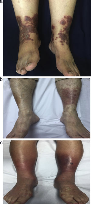 Case 1, a 61 yo female patient with (a) bilateral erythematous-purpuric plaques in lower limbs. (b) Case 3, a 78 yo male patient with unilateral, erythematous, purpuric plaque in posterior right lower limb. (c) Case 4, a 88 yo female patient with bilateral, erythematous, purpuric plaques in lower limbs.
