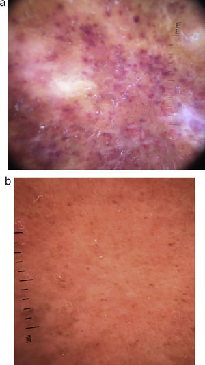 (a) Case 1 histology: diffuse infiltration of eosinophils dispersed and invading necrotized superficial blood vessels. (b) Case 2 histology: fibrinoid necrosis of superficial blood vessels surrounded by eosinophils.