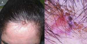 A, Skin-colored nodule on which a bluish papule is located. B, Dermoscopy showing a salmon-pink area, linear vessels, and homogeneous blue pigmentation.