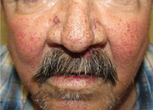 Multiple facial telangiectases on a patient with HHT.