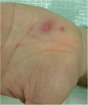 Two erythematous papules with diameters of 2 and 4mm, respectively. The larger papule shows central hyperkeratosis and a perilesional erythematous halo.