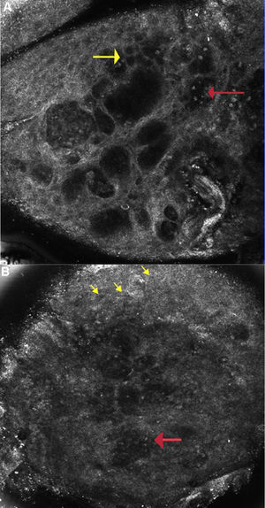 A Allergic Contact Dermatitis: Reflectance confocal microscopy image (0.5×0.5mm) at the level of the spinous layer (∼30 microns depth) shows spongiosis and exocytosis (yellow arrow) and multiple microvesicles with lymphocytes and detached keratinocytes (red arrow). Figure 2B: Irritant contact dermatitis: Reflectance confocal microscopy image (0.5×0.5mm) shows disruption of stratum corneum with detached corneocytes and early parakeratosis (yellow arrows) and confluence of microvesicles with inflammatory cells infiltration (red arrow) below.