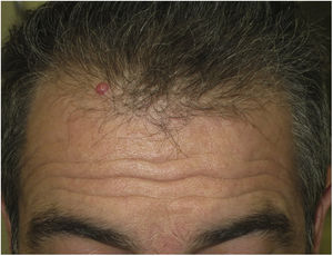 Tumor that first appeared 4 months previously on the hairline of an adult.
