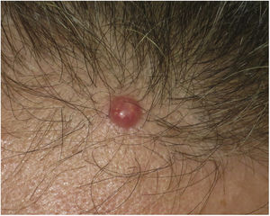Firm, shiny, and well-delimited erythematous-pink nodule measuring 8mm in diameter.