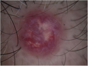 Dermoscopy showing alternate intense erythematous tones at the periphery, with prominent vascularization and irregular whitish areas in the center.
