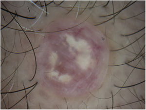 Contact dermoscopy shows that the marked vascular component has almost disappeared and that the predominant finding is whitish-gray structures on a pale pink background.