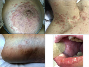 Exudative erythema multiforme-like lesions on the skin and oral erosions.