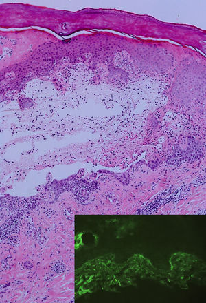 Partially re-epithelialized subepidermal blister with neutrophilic and eosinophilic inflammatory infiltrate (hematoxylin-eosin, original magnification ×20). The direct immunofluorescence image (bottom right) shows focal linear C3 deposition in the basement membrane.