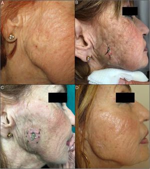 A, Indurated subcutaneous plaque of 2.5×3 cm in diameter in the parotid region. B, Parotid fistula with secretion of saliva from the defect 7 days after skin biopsy. C, Parotid fistula 3 weeks after treatment, before beginning botulinum toxin treatment. Botulinum toxin was injected subcutaneously at the 6 indicated sites around the defect. D, Final outcome after botulinum toxin treatment.