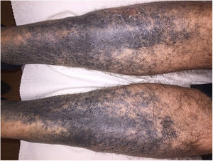 Bilateral, symmetric, blackish pigmentation with irregular borders on the anterolateral aspects of both legs.