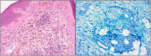 A, Abundant siderophages in the deepest areas of the dermis (hematoxylin-eosin, original magnification ×20). Cytoplasm containing slightly refringent golden-brown granules. B, Positive Perls staining (iron), revealing bluish, granular cytoplasm inside the macrophages.