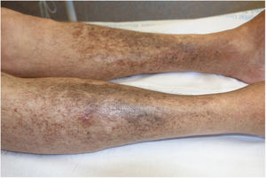 Significant lesion improvement and decreased pigment intensity after suspension of levofloxacin treatment.