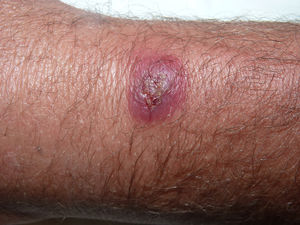 Indurated, erythematous-violaceous nodule with a central crust on the dorsum of the wrist.