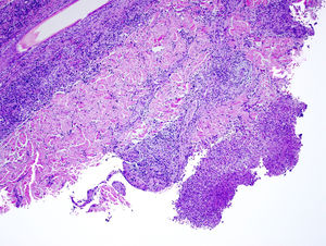 Histology revealing a superficial and deep neutrophilic inflammatory infiltrate forming focal dermal abscesses (hematoxylin-eosin, original magnification ×10).