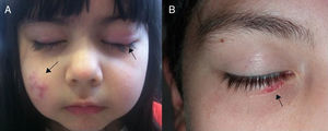 A, Girl with erythematous nodules on the right cheek and a chalazion on the left upper eyelid. B, Boy with an erythematous lesion on the lower right eyelid.