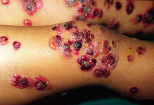 Skin lesions in a child with linear IgA bullous dermatosis. Note the numerous tense blisters arranged in a rosette-like pattern with a central crust.