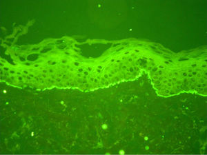Direct immunofluorescence findings in linear IgA bullous dermatosis. Note the linear IgA deposits along the basement membrane zone.
