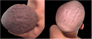 Anteroposterior folds forming furrows and ridges on the scalp.