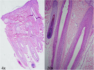Skin biopsy of the scalp showing follicular hypertrophia and hyperplasia, with no other histologic abnormalities of interest.