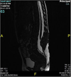 Wide spinal column of CSF, compatible with untethered cord.