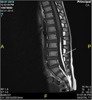MRI T1 lipoma from the filum terminale to S2.