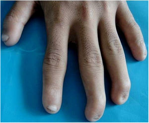 Anonychia of the ring and little finger of the left hand with flexion deformity of the middle and ring finger.