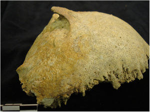 Dry skull image of occipital bone with type 3 EOP. Image kindly provided by Mr Richard Dabbs. Museum of London attribution to Bermondsey Abbey SK2722 / © Museum of London.