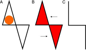 A, Defect and design of an east-west flap. B, Release and advancement of the triangular flaps. C, Closure (suture lines).