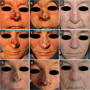 Incision lines drawn on patients 1, 2, and 3 (A, D, and G, respectively), their results immediately after surgery (B, E, and H), and their results at the 6-mo follow-up visits (C, F, and I).
