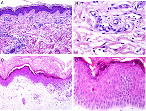A, Biopsy of an evanescent rash in a patient with Sill disease, showing a superficial perivascular lymphohistiocytic inflammatory infiltrate (hematoxylin and eosin [H&E] ×100) with some neutrophils (B, H&E ×400). C, In biopsies of patients with chronic Still disease, a superficial perivascular inflammatory infiltrate is still evident with some neutrophils (H&E ×100), but necrotic keratinocytes are also observed in the upper parts of the epidermis (D, H&E ×400).