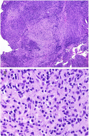 A, At low magnification, Ig4-related disease should be suspected on finding an infiltrate rich in plasmatic cells coexisting with areas of concentric fibrosis (hematoxylin and eosin [H&E] ×40). B, Infiltrate rich in plasmatic cells in the case of IgG4-related disease (H&E ×400).