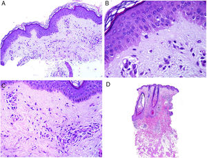 Skin involvement in a case of lupus with systemic manifestations. Absence of epidermal atrophy (A, hematoxylin and eosin [H&E] ×100). There is very little vacuolar degeneration of the basal layer and no evidence of thickening of the basal membrane (B, H&E ×400). The dermal inflammatory infiltrate is discrete and may contain neutrophils (C, H&E ×200). D, In contrast, discoid lupus erythematosus shows infundibular dilatations, prominent horny plugs, and marked periadnexal infiltrate (H&E ×20).
