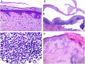 A, Numerous apoptotic figures in the basal epidermal layer (hematoxylin and eosin [H&E] ×200). The number of apoptotic keratinocytes has been correlated with lupus activity. B, Subepidermal detachment in a case of bullous lupus (H&E ×40). C, Presence of numerous polymorphonuclear cells in chronic infiltrate from a patient with bullous lupus (H&E ×400). D, Perivascular infiltrate in an ulcerated lesion corresponding to skin involvement in Kikuchi disease (H&E ×40).