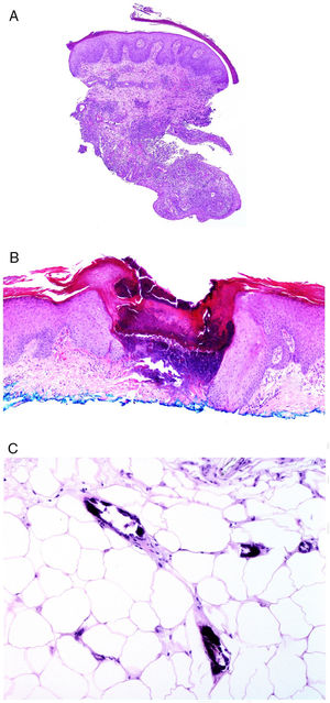 A, Fistulous trajectory in biopsy of a metastatic Crohn lesion on the leg (hematoxylin and eosin [H&E] ×20). B, Perforating collagenosis with elimination of eosinophilic collagen fibers by a crater of necrotic material (H&E ×20). C, Calciphylaxis showing the calcified walls of small calliber subcutaneous vessels (H&E ×200).