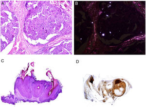 A, Sarcoid epithelioid granulomatous reaction in the dermis in a case of silica granuloma (hematoxylin and eosin [H&E] ×100). B, In the examination of sarcoid granulomas with polarized light, numerous intensely birefringent particles can be observed (H&E ×100, polarized light). C, Typical example of trichilemmoma (H&E ×20); even at this magnification, characteristic cytoplasmic cellular vacuolizations can be observed. D, Preservation of PTEN expression in a sporadic trichilemmoma, not associated with Cowden syndrome (PTEN × 30).