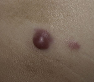 Clinical image. Smooth pinkish dome-shaped nodule measuring 2cm on the right buttock. Note the infiltrated subcutaneous base and the adjacent satellite nodule.