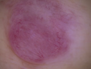 Dermoscopy image. Homogeneous salmon-pink color with multiple prominent poorly focused serpentine (linear-irregular) vessels. The lesions are found mainly on the periphery of the nodule. Note the whitish structures in the center of the lesion.