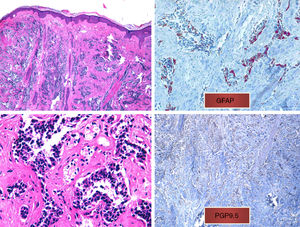 A, Diffuse infiltrate in the papillary and reticular dermis of tumor cells, sparing the epidermis (hematoxylin-eosin, original magnification ×10). B, Tumor cells with hyperchromatic nuclei and marked pleomorphism (hematoxylin-eosin, original magnification ×40). C, Positive immunohistochemistry (glial fibrillary acid protein, original magnification ×40). D, Positive immunohistochemistry (protein gene product 9.5, original magnification ×20).