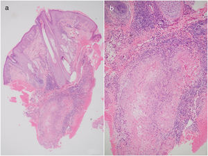 A and B. Hematoxylin-eosin, original magnification ×10 and ×20, respectively.