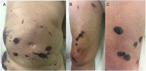 A, Abdominal ecchymotic plaques. B, Necrotic lesions on the right thigh. C, Tense hemorrhagic blisters in the distal area of the right leg.