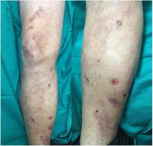 Resolution of necrotic lesions 15 days after discontinuing heparin treatment.